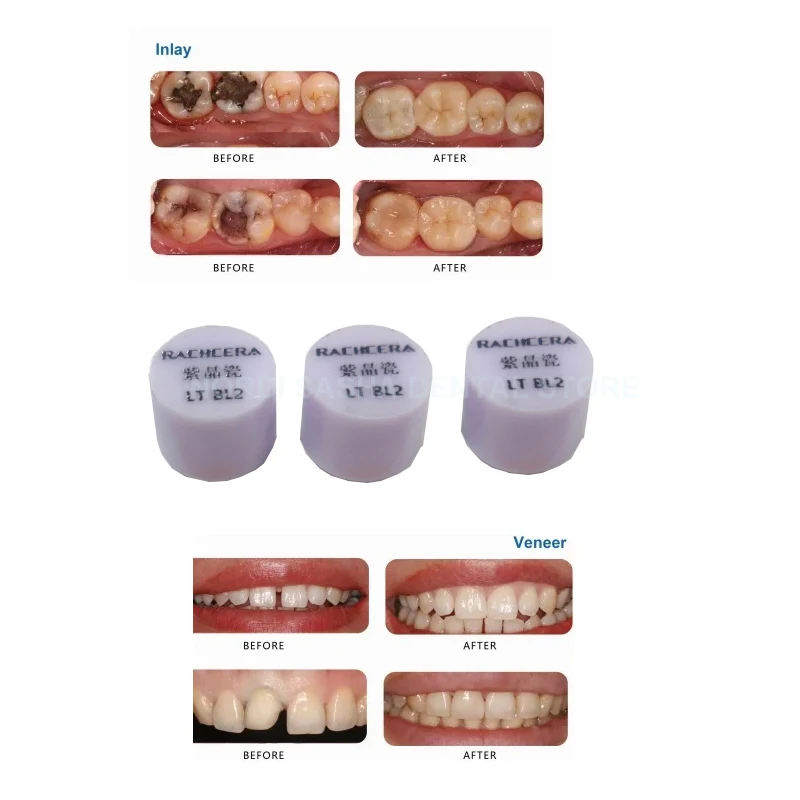 RACHCERA-كتلة ديسيليكات الليثيوم لقشور التاج ، سبائك السيراميك ، Emax الأسنان ، HT ، LT ، A1-D4 ، CAD ، CAM ، اضغط ، 10 قطعة