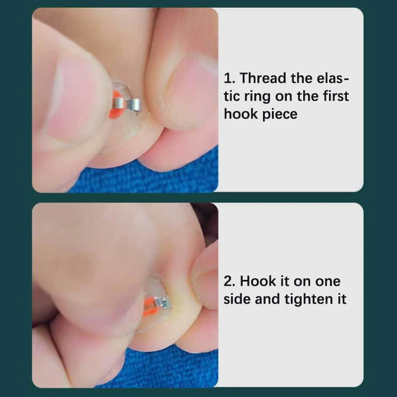 Ingrown Toenail Cor…