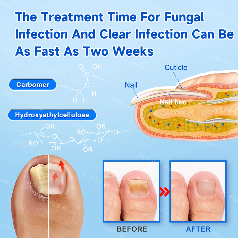 Fungal Nail Laser Device Repair Fast Nails Fungus Onychomycosis Anti Thyroiditis Relief Pure Natural Oil Foot Care Beauty Health