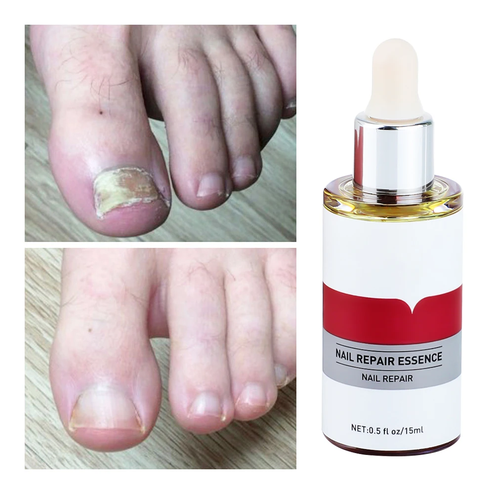 Nail Fungal Treatment Feet Care Essence Nail Foot Whitening Toe Nail Fungus Removal Gel Anti Infection Paronychia Onychomycosis