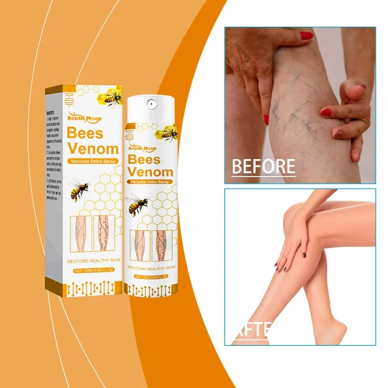 Bees Venom Varicose Veins Spray Legs Dilated Spider Legs Vasculitis Phlebitis Angiitis Relief Foot Care Medicine Herbal Formula