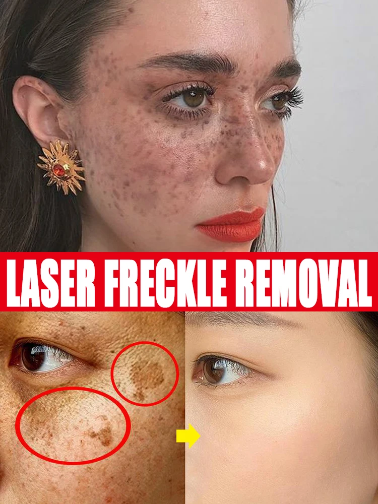 

Laser Dark Spots Melasma Freckles Face Whitening