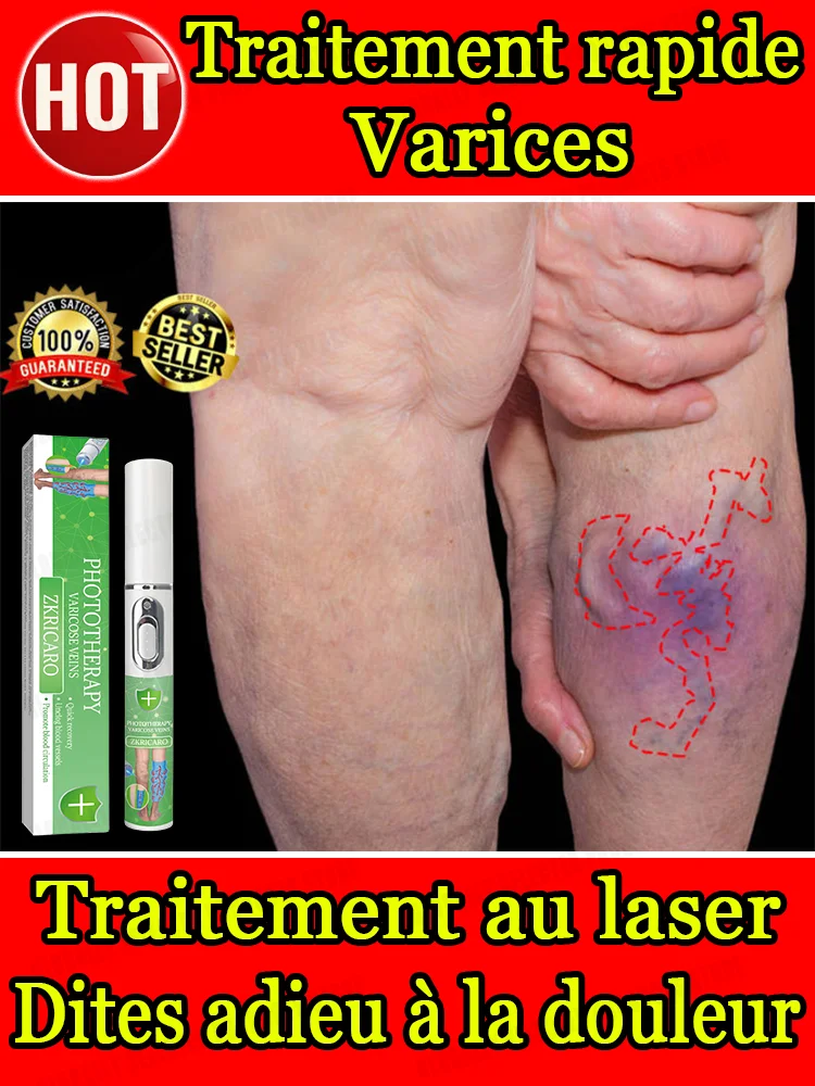laser,Débarrassez-vous des varices
