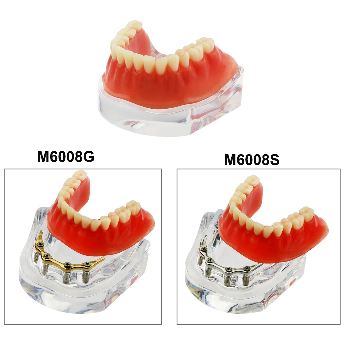 Dental Model Teeth Implant Restoration Dental Prosthesis Model   For Dentist Patient Communication Treatment Study Demo