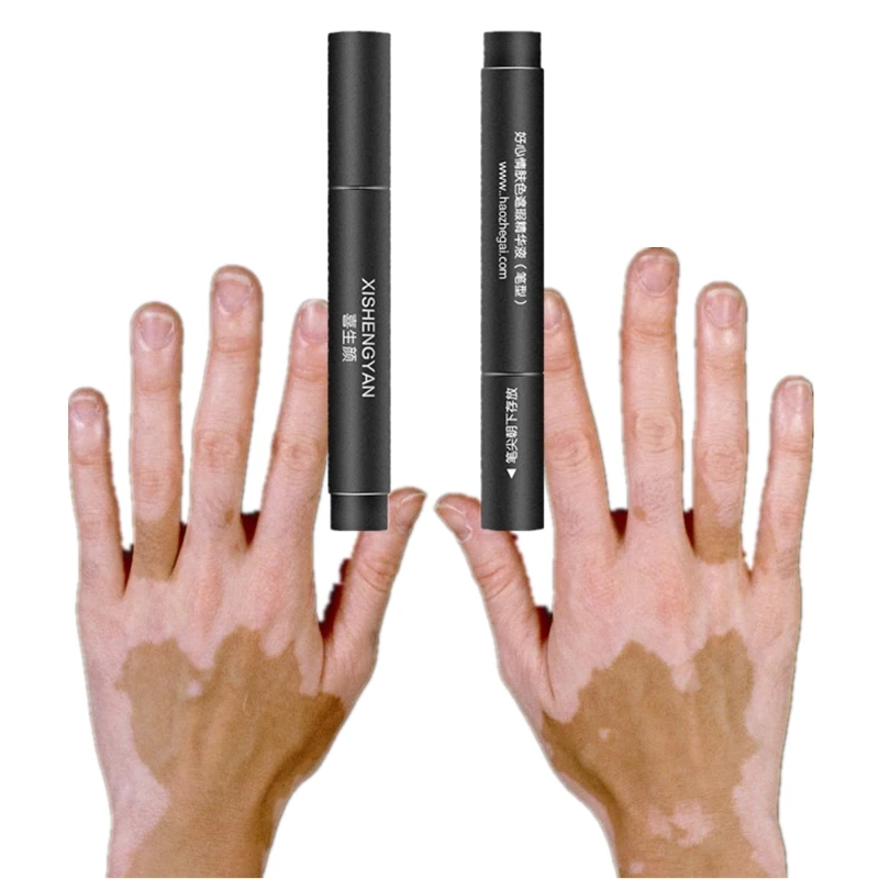 

Skin Vitiligo Concealer Makeup Cream Pen Long-lasting Waterproof NO Treatment Face Body Cover for Women Men Vitiligo