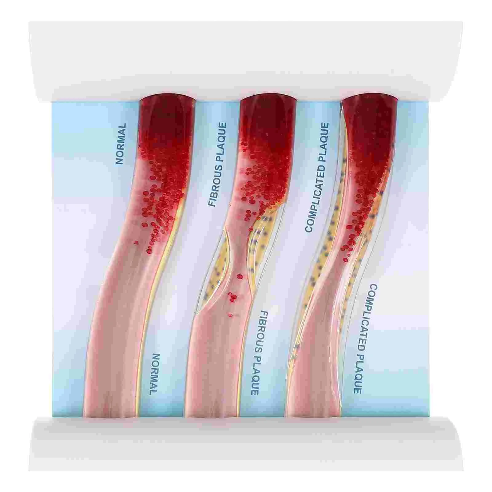 Hot sale Dynamic Blood Vessel Model Cardiovascular Blockage Contrast Model Thrombosis Model for Teaching Explanation
