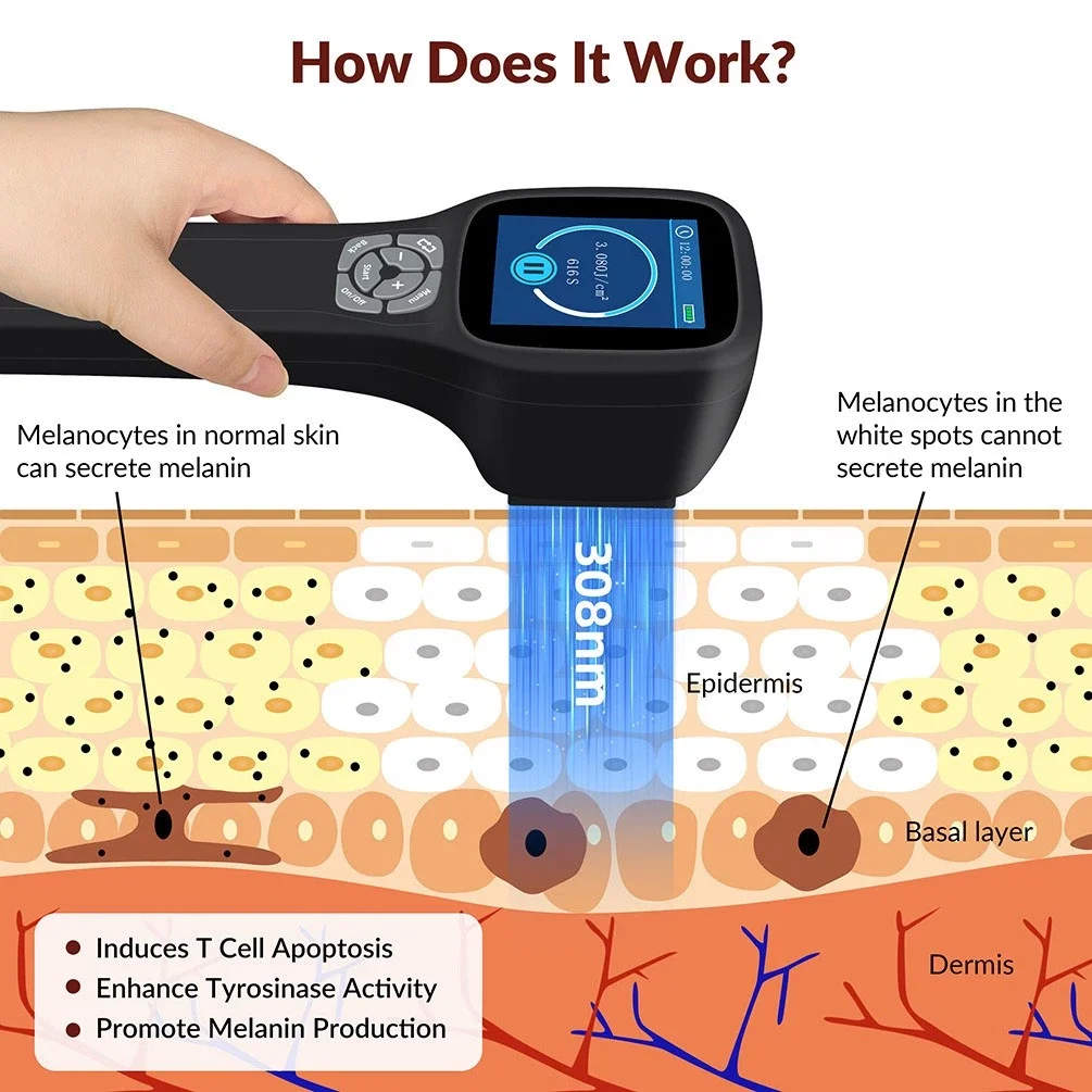Handheld 308nm UVB Phototherapy Device 49 Diodes Targeted Light Therapy for Vitiligo Psoriasis Dermatitis Rechargeable