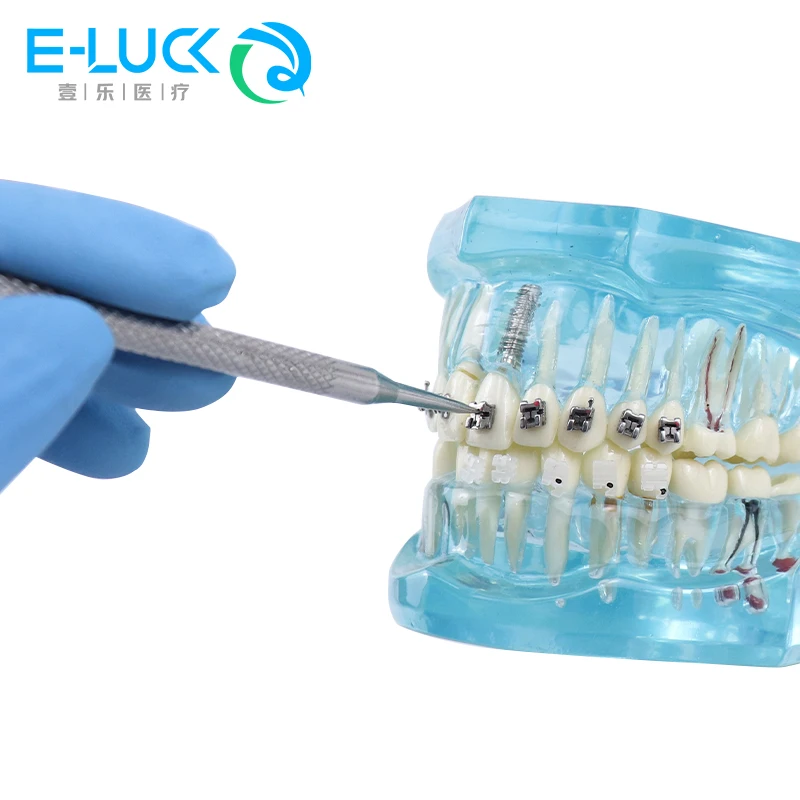 Dental Selbst Halterung Opener Werkzeug Kieferorthopädische Öffnung Selbst Beleitende Passive Halterung Stahl Edelstahl Instrumente – Detail 6