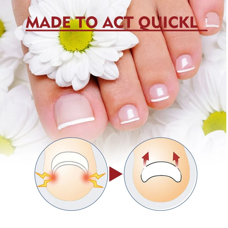 Anti-nail groove relief oil soft nail polish repair ingrown toenails thickening onychomycosis Treatment fungal Infection care