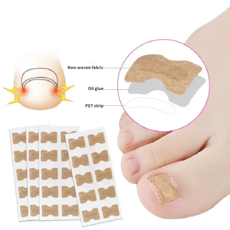 100-300pcs Toenail Correction Stickers Waterproof Patch Paronychia Treatment Nail Pedicure Tools Elastic Straightening Clip