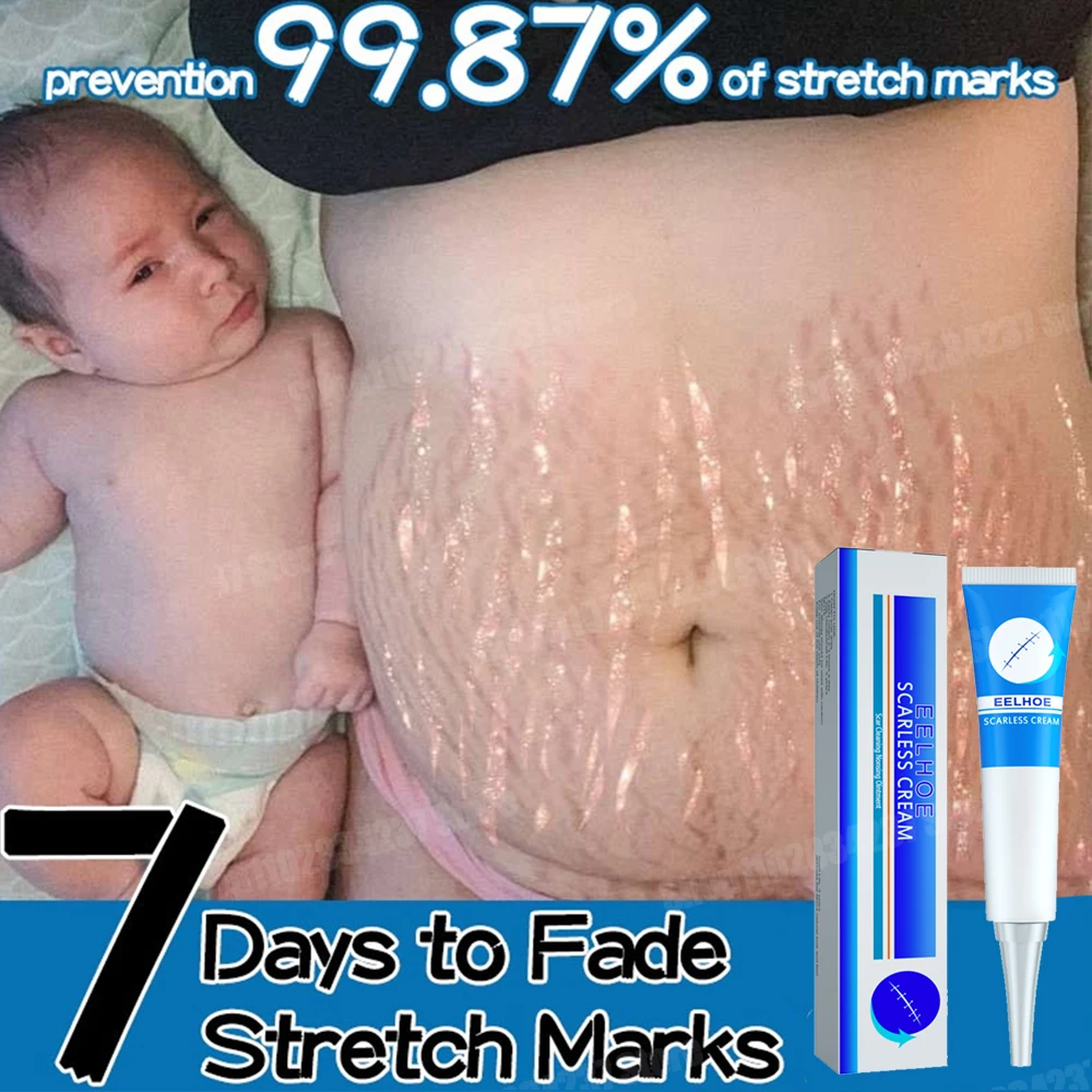 

Pregnancy Stretch Marks Cream Remove Old Marks Light Lines Firming Skin Postpartum Recovery