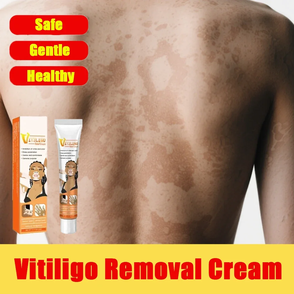 

Dermatologist Recommended Vitiligo Care Cream White Spots Reduction Formula for Skin Spot