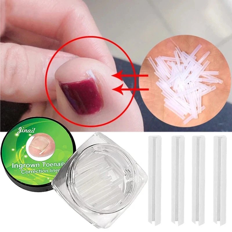 10pcs/box Ingrown Toenail Correction C-shaped Nail Groove Pads Cuttable Nail Orthopedic Clip Brace Pain Relief Foot Care Tool