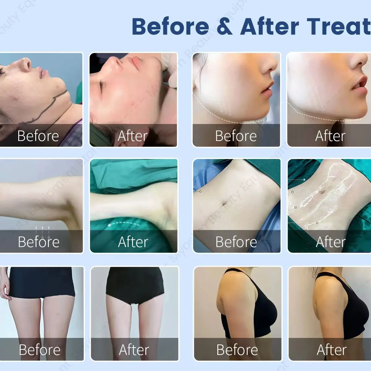 980nm 1470nm Dual Wavelength Fiber Diode Lase Machine Endolift Facial Lifting Large Area Lipolysis Skin Tightening