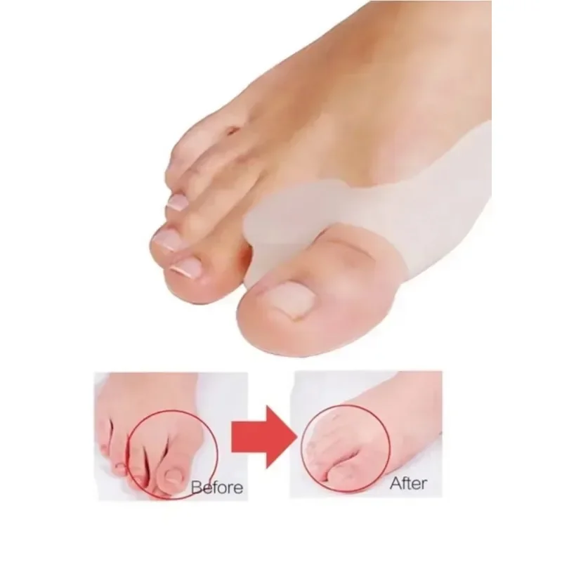 2PCS Corrector Separator Bunion Foot Toe Hallux Valgus Protector SiliconeGel Thumb Finger Straightener Adjuster Foot Care Tool