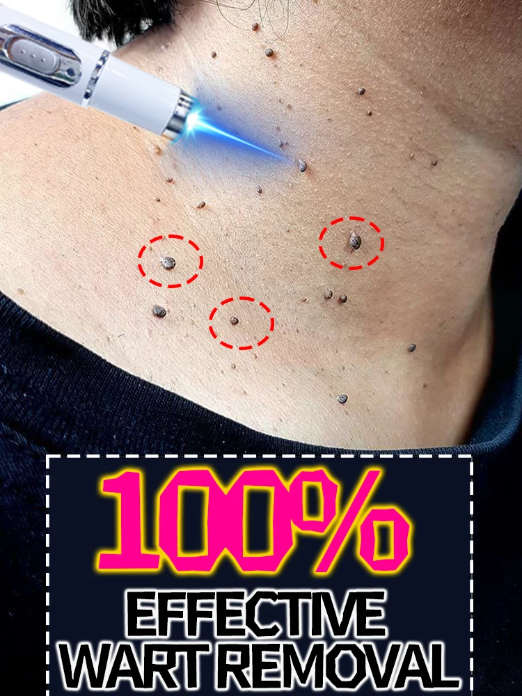 Bolígrafo de terapia de luz azul de segunda generación, 100% eficaz en eliminar verrugas