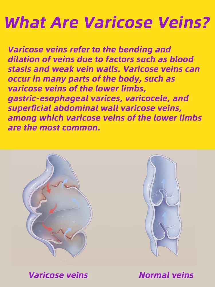 Varices