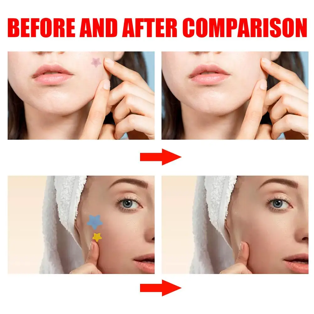 200 قطعة رقعة حب الشباب على شكل نجمة العناية ببشرة الوجه تتلاشى العيوب علامات البثور مغلقة حب الشباب العيوب غطاء حب الشباب بثرة رقعة إصلاح 2026