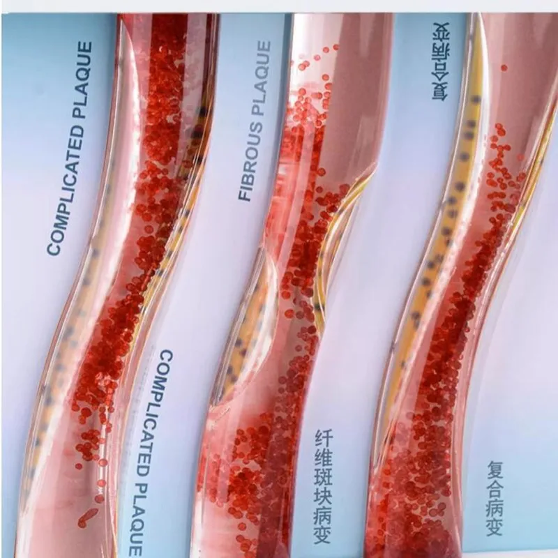 Blood vessel blockage compared with human blood lipid plaque model thrombus mold artery dynamic blood vessel model vascular prop