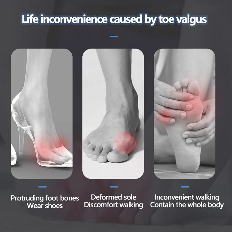 Correcteur de pouce en Gel de Silicone, 2 pièces, correcteur d'oignon, orteil, Hallux Valgus, séparateur de protection, lisseur de doigts, ajusteur, outils de soins des pieds