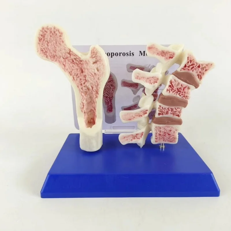 Anatomical surface of the leg bone in an anatomical model of human femoral osteoporosis