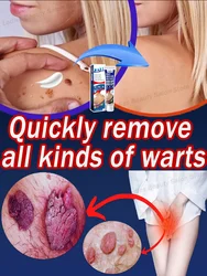 Make your wart-free life comfortable, suitable for everyone, fast effect