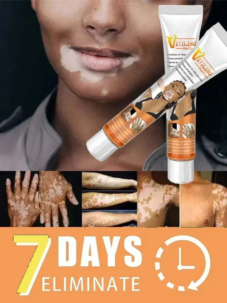 Novo produto para remover manchas brancas, anti-vitiligo, anti-vitiligo, anti-vitiligo, cuidados com a pele, 0903