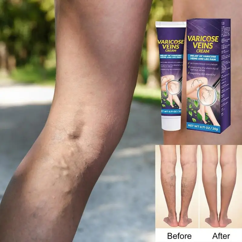 20g Varicose Vein Cream Herbal Angiitis Remedy Ointment Relief Veins Hurt Phlebitis Legs Varicose Vein Cream For Legs Care