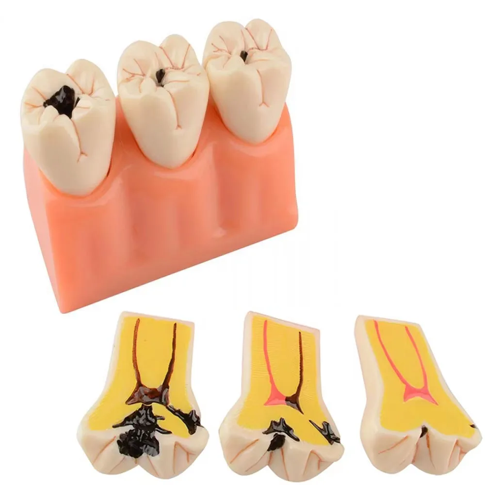 

Dental Decayed Teeth Model Caries Disease Decomposition Tooth Replica for Dentist Teaching Training and Patient Education Tools