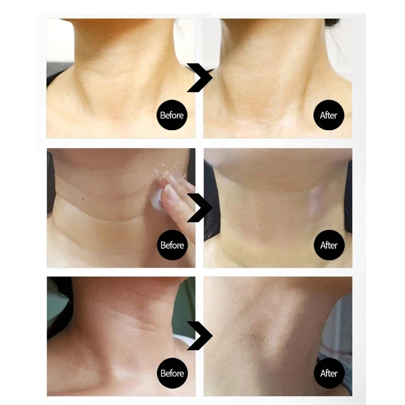 Crema para el cuello con hilo de naita, 100ml, solución de adenosina 5%, péptidos de Colágeno Hidrolizado, crema Facial para arrugas de la piel