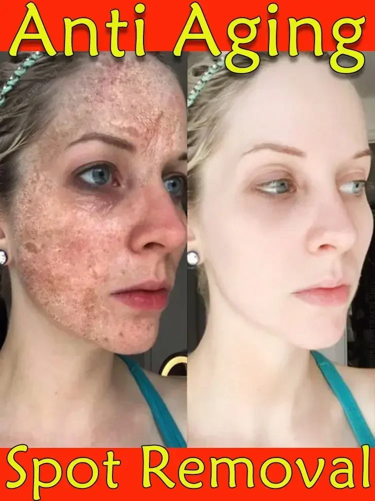 Rimuovi macchie scure lentiggine sbiancante rimuovi Melasma melanina idrata illumina la cura della pelle del viso liscia