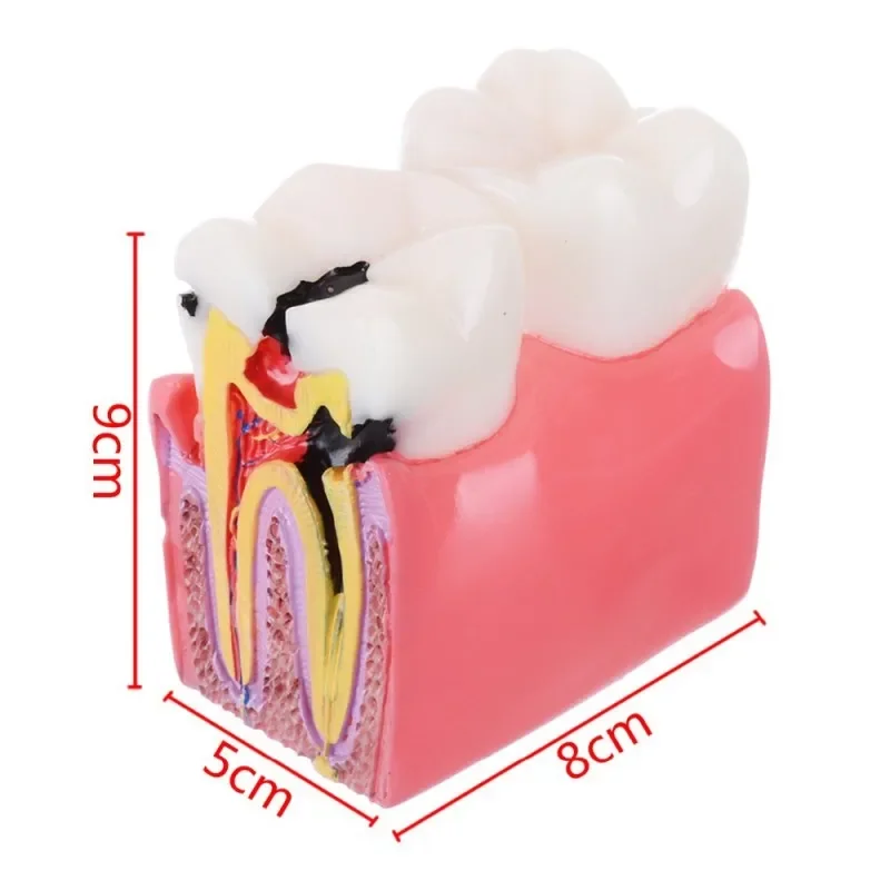 6 Times Dental Caries Comparsion Models Dental Teaching Model For Dental Study Teaching Dental Anatomy Endodontics Education