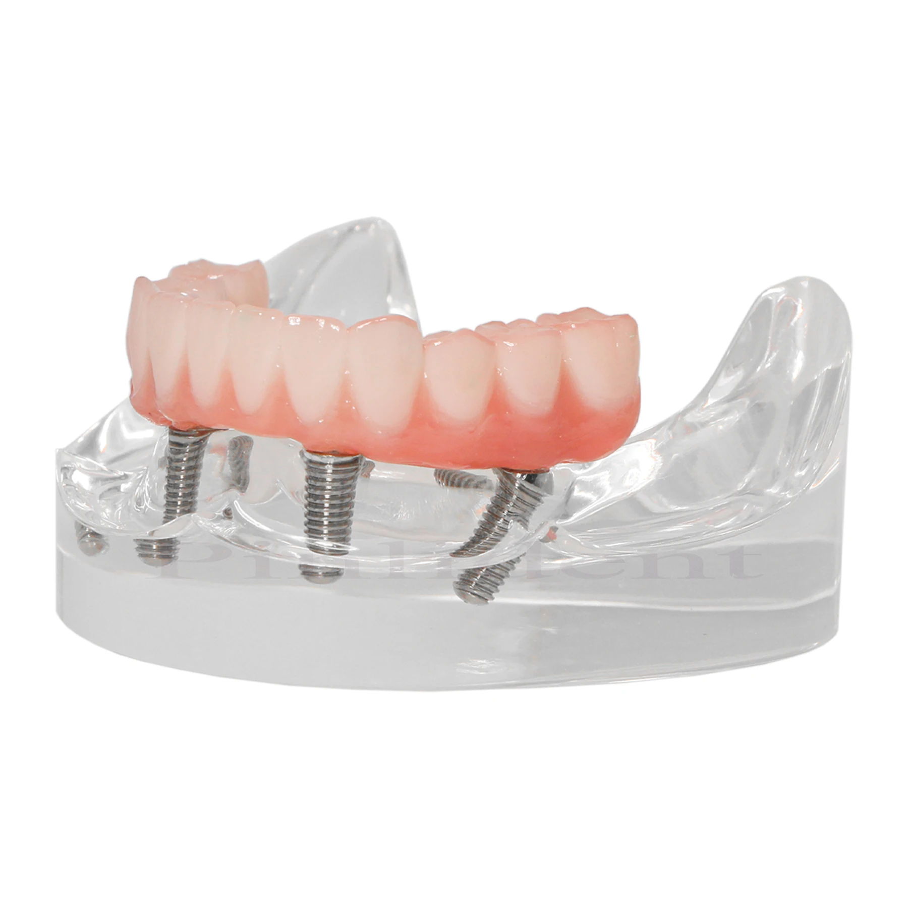 Mandibular Dental Implant Teeth Model M6027 Clear Lower Jaw 4 Overdenture Type Modle With 4 Removable Screws For Studying