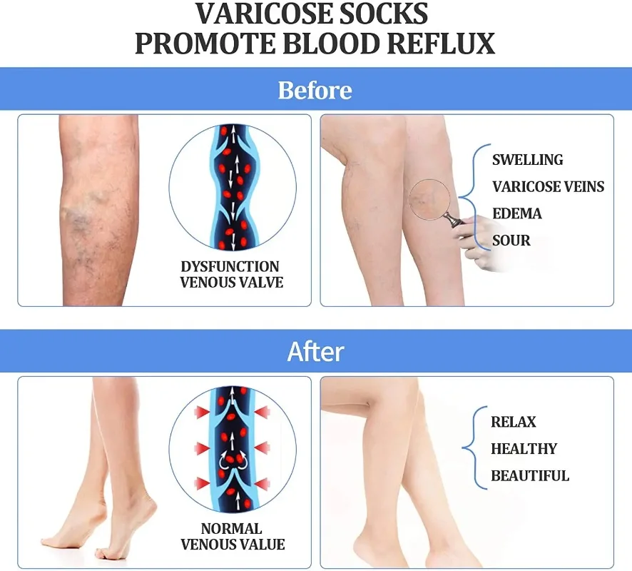 Medical Compression Pantyhose for Varicose Veins Stockings 20-30 MmHg Compression Support Pantyhose Plus Size Thights Slimming