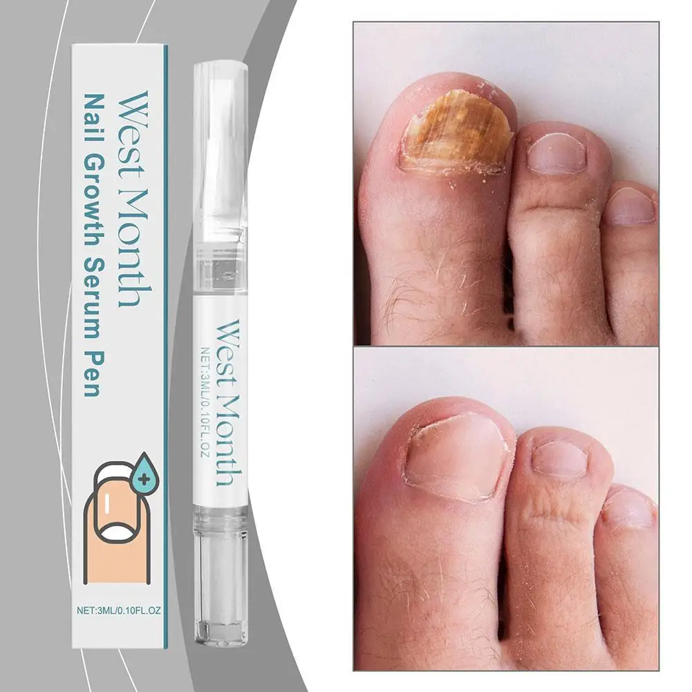 Unha Fungal Tratamento Essence Pen, Anti Onychomycosis Remoção Gel, Amaciar cutícula polonês, Nutrição Óleo De Fungo, Q7Z3