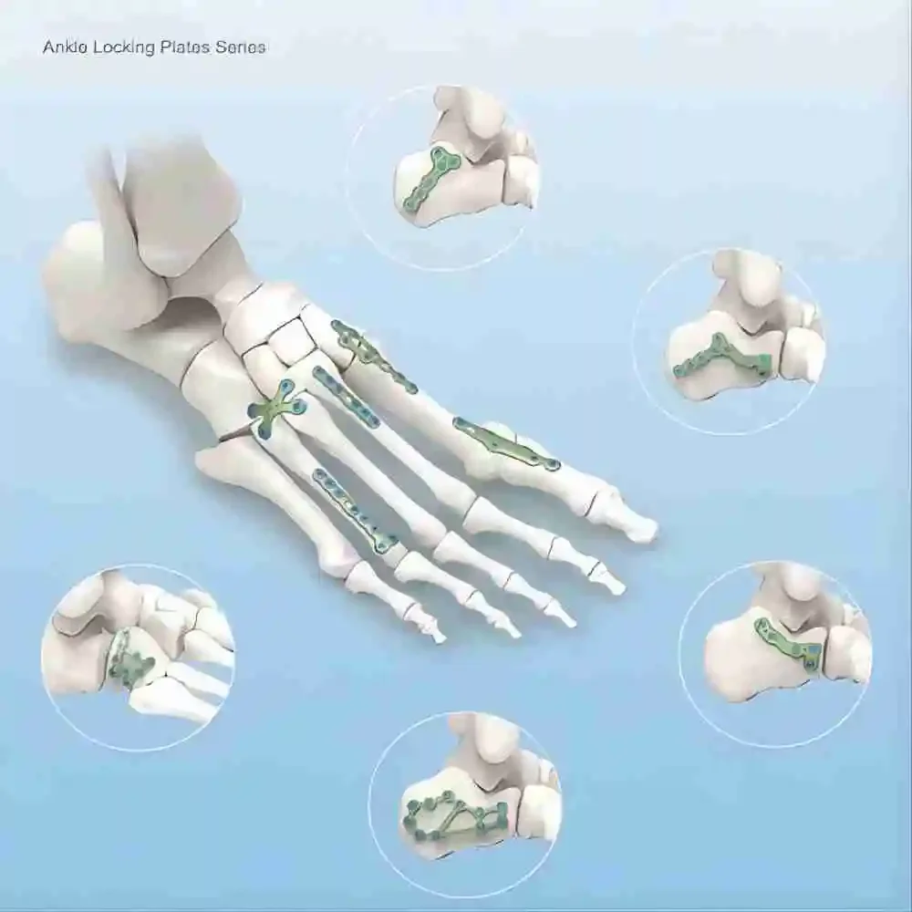 Anterior Cervical Spine Retractor Instrument Kit  Titanium Surgical Instrument Sets for Spine Surgery