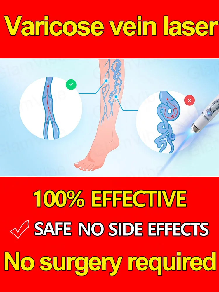 

Varicose vein laser eliminates vasculitis and phlebitis, relieves spider leg pain