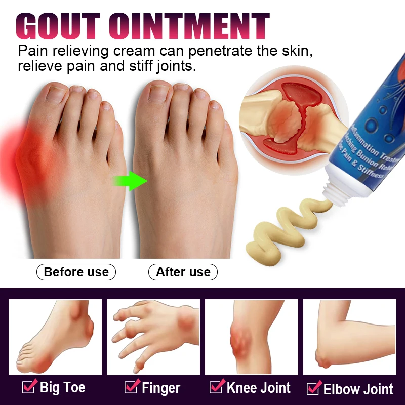 20g/pcs Thumb inflammation gout ointment is used to treat thumb inflammation, relieve itching and pain, and reduce inflammation