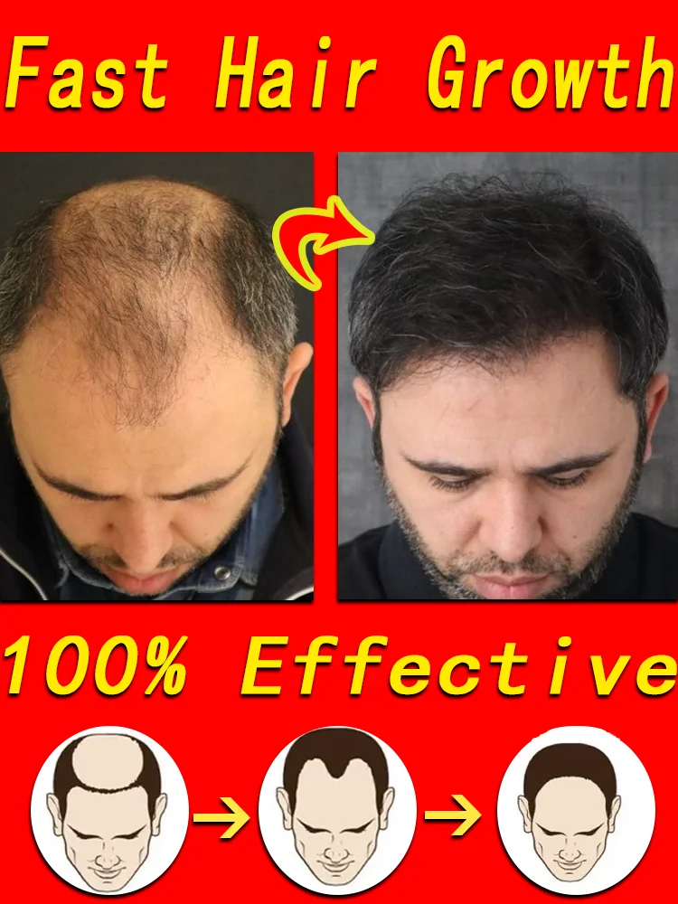 Hair Growth Products Biotin Hair Oil Fast Regrowth Anti-Hair Loss Serum Thickener Scalp Treatment for Men Women Hair Care