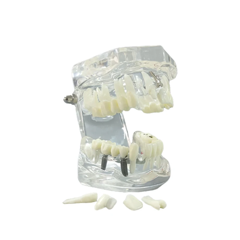 Dental Orthodontics Implant Tooth Models Prosthodontic Teaching Model Study Removable  Demonstration Resin Dentistry Accessories