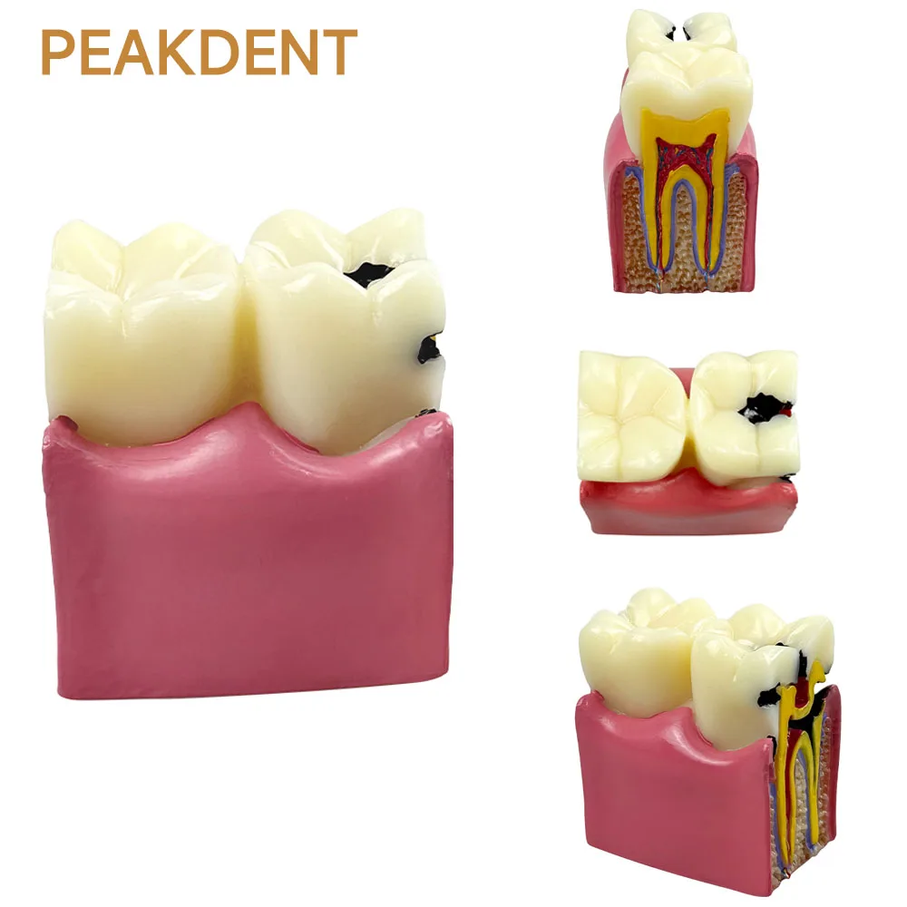 

1pcs Dental Caries Tooth Model 6-Stage Tooth Decay Comparison Study Model Bilateral Caries Comparison Pathology Teaching Tool