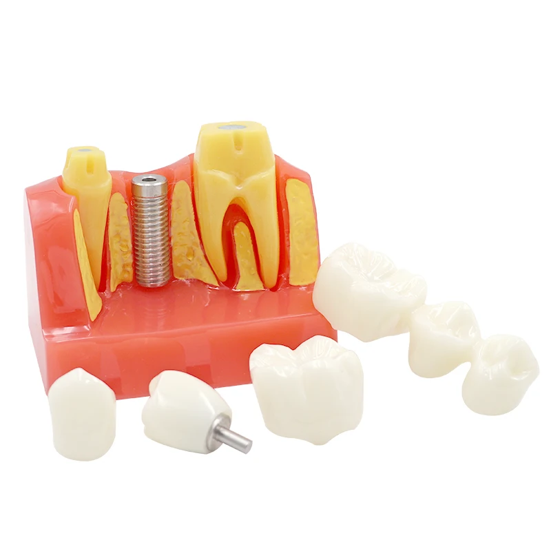 

Dental Implant Four Times Teaching Teeth Model 4 Times Model Dentist Training Pathology Model