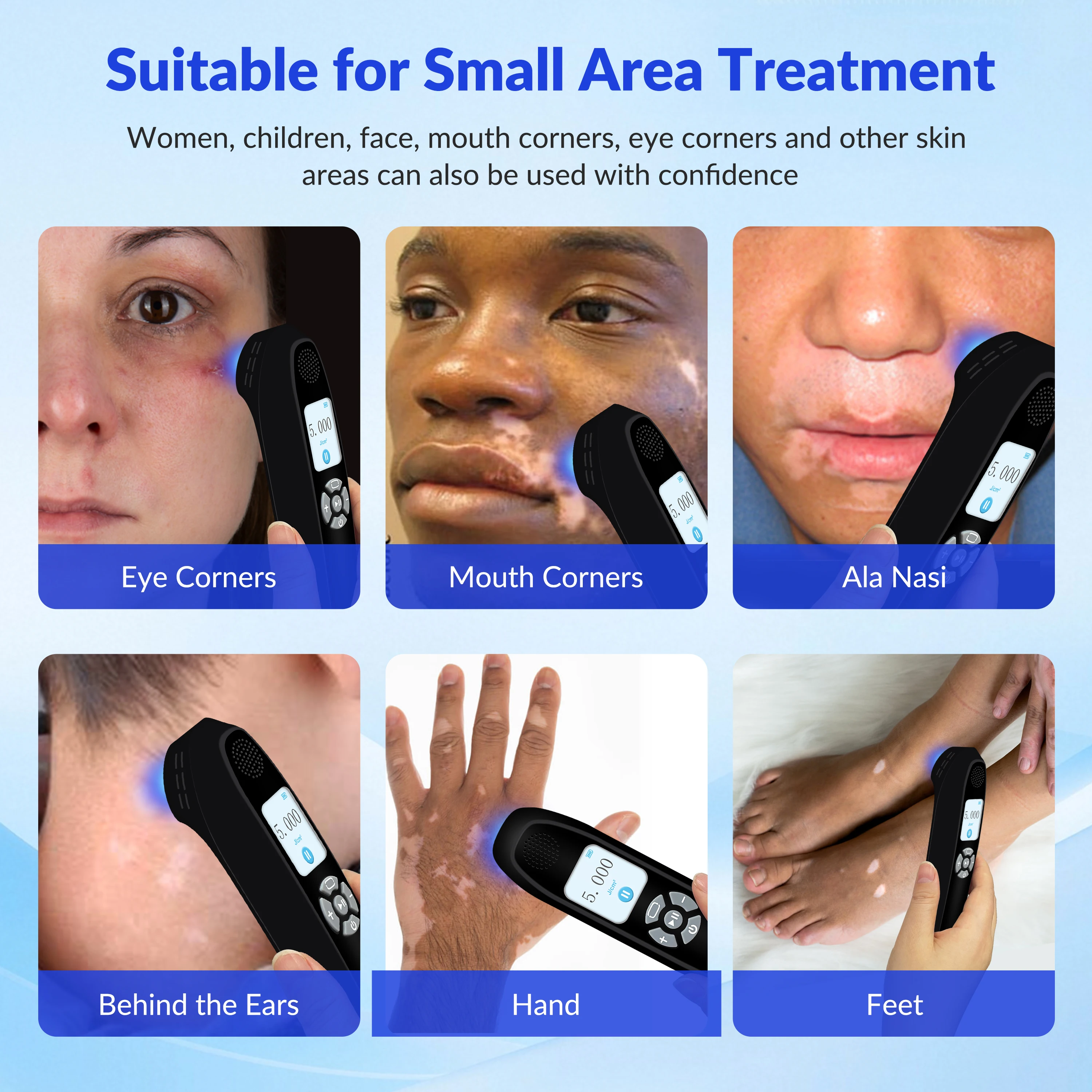 GOOD Home Use Full Body 308nm Excimer UVB Phototherapy Lamp for Vitiligo Psoriasis and Skin Conditions