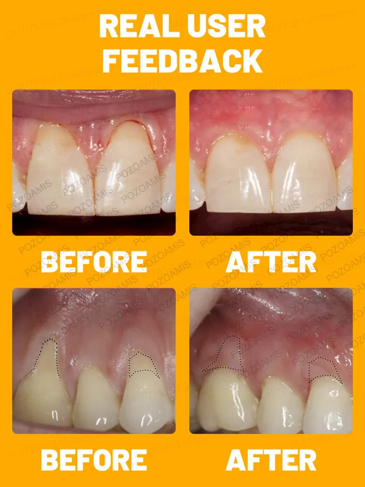 Restore gums