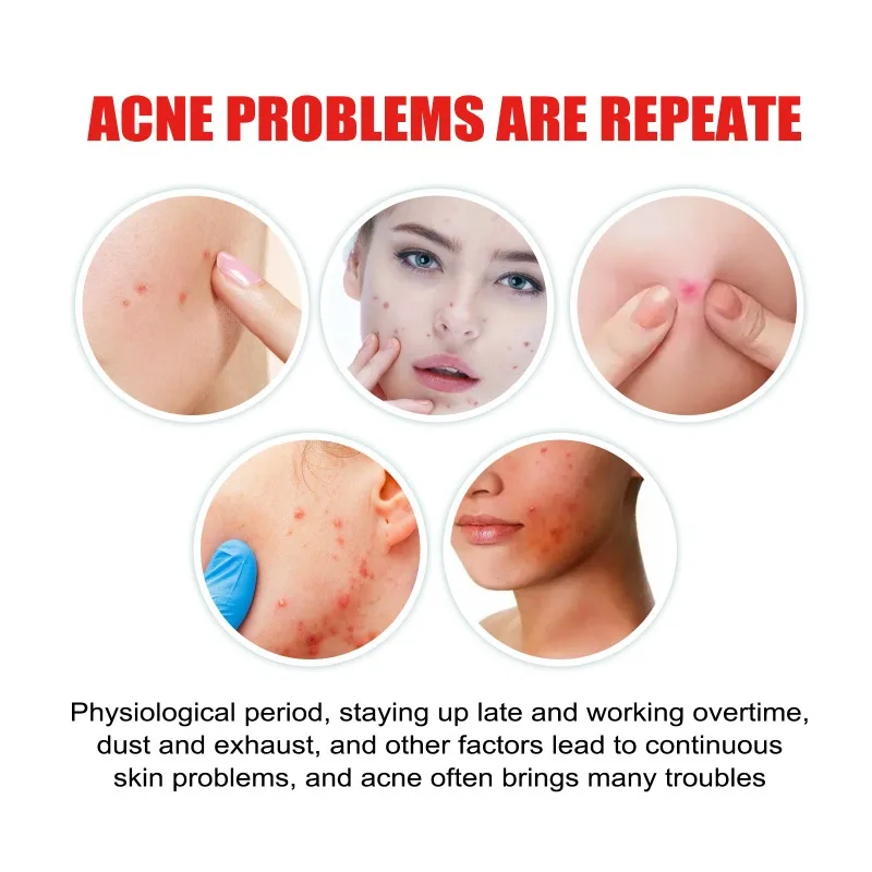 Maan Acne Puistje Patch Gezicht Onzichtbare Stickers Snel Effect Behandeling Verwijderen Patches Schoonheid Acne Tools Gezicht Huidverzorging