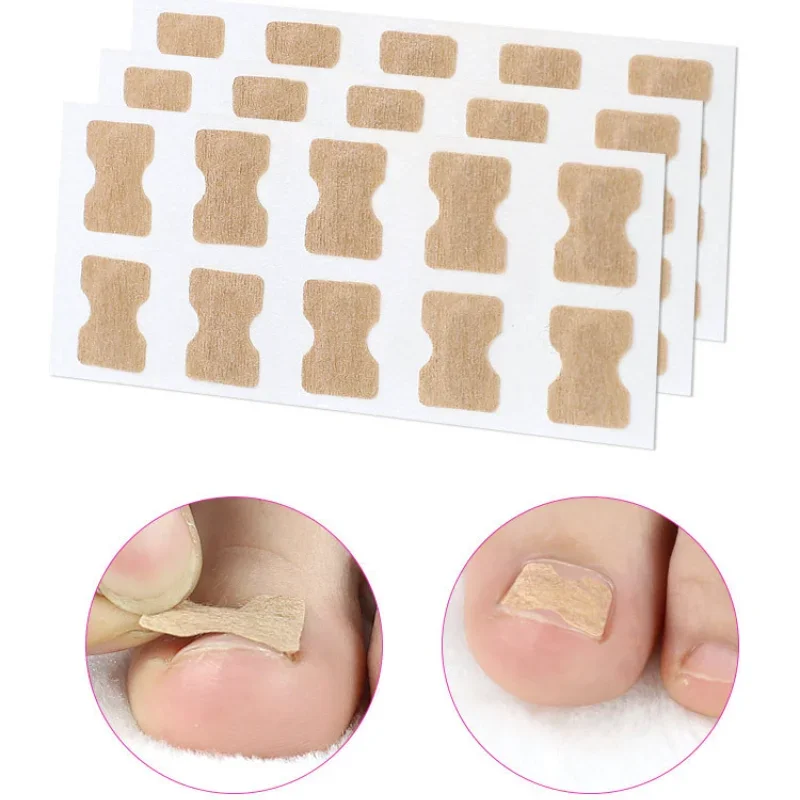 20/50/100pcs Nail Correction Stickers Ingrown Toenail Corrector Patches Paronychia Treatment Recover Corrector Pedicure Tools