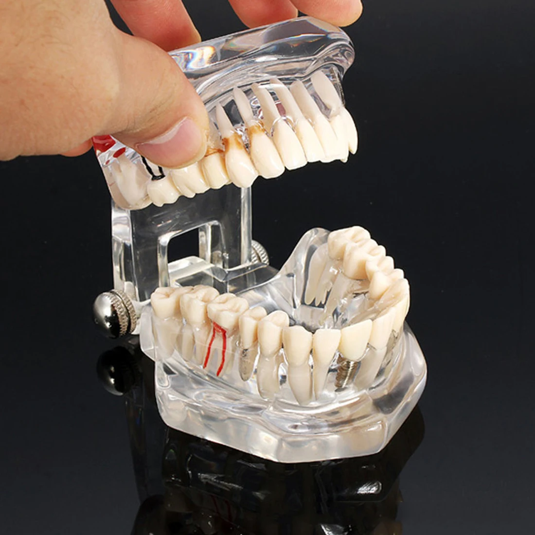3Pcs Dental Implant Teeth Study Model Repairable Resin Model Of Diseased Teeth For Teach And Research In Medicine Dental Disease