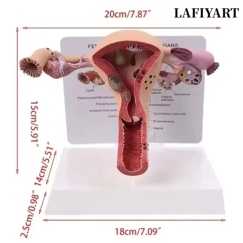 Female Pathological Uterus Ovary Anatomical Model, Female Reproductive Organ Lesion Model, Gynecology Biology Teaching Aid, Medi