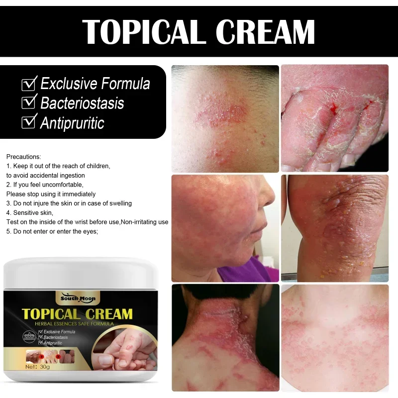 Creme erval antipruriginoso profissional, tratamento da pele seca, mordida do mosquito, anti coceira, creme antipruriginoso, cuidados com a pele