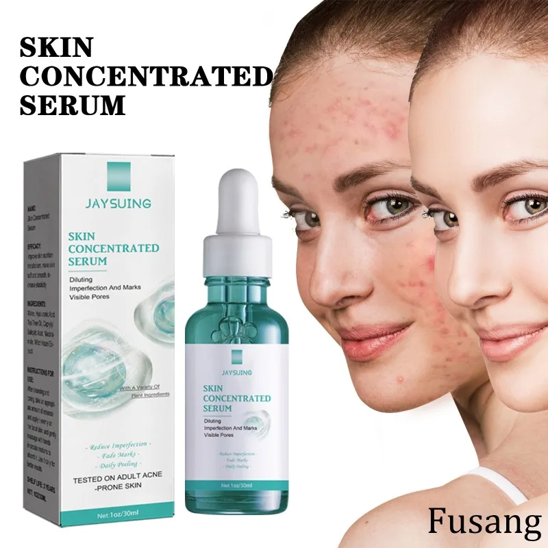 Women Acne Removal Serum Effective Clears Blemish Pimple Remover Gentle Remove Acne Cream for Face Whitening Oil Control Essence